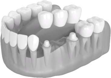 Имплантация зубов - Стоматология 