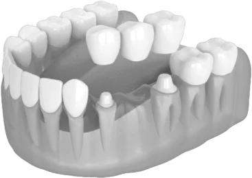 Имплантация зубов - Стоматология "Мандарин" - 6