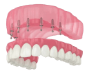 Базальная имплантация зубов - Стоматология 