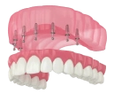 Базальная имплантация зубов - Стоматология "Мандарин" - 11