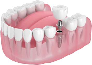 Имплантация зубов - Стоматология 