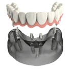 Прогрессивные методики имплантации зубов в сети стоматологических клиник Мандарин
