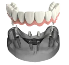 Прогрессивные методики имплантации зубов в сети стоматологических клиник Мандарин