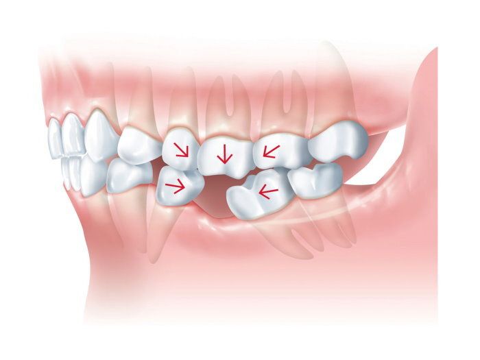 Протезирование зубов - Стоматология 
