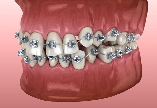Ортодонтия - Стоматология 