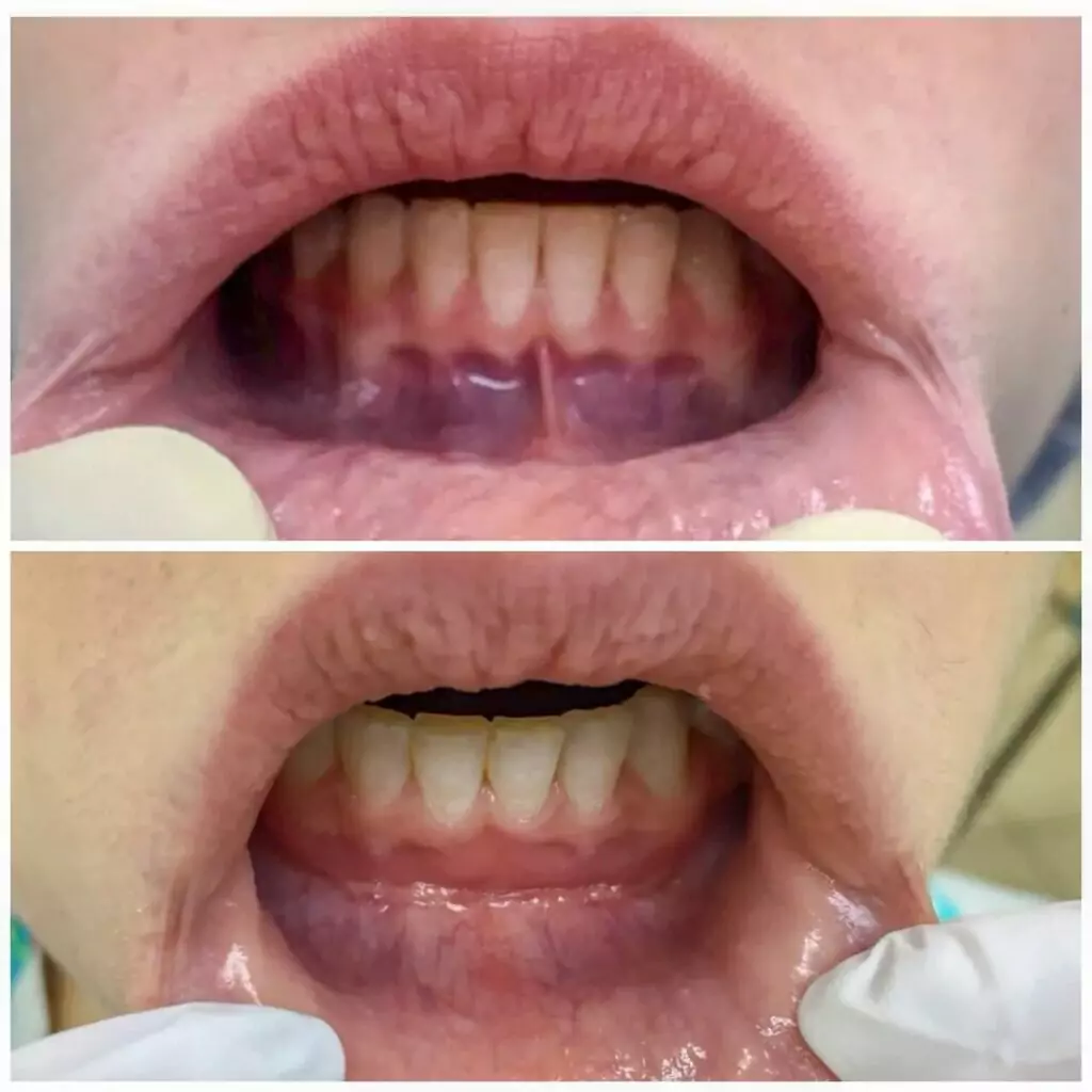 Операции на мягких тканях полости рта