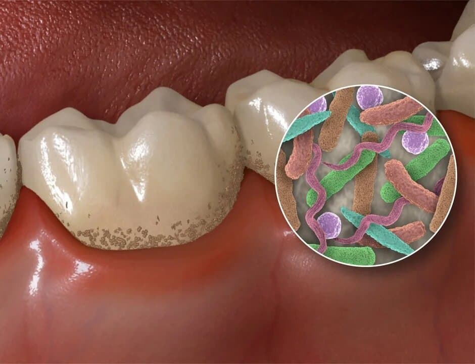 Комплексная гигиена полости рта 5 в 1 - Стоматология 