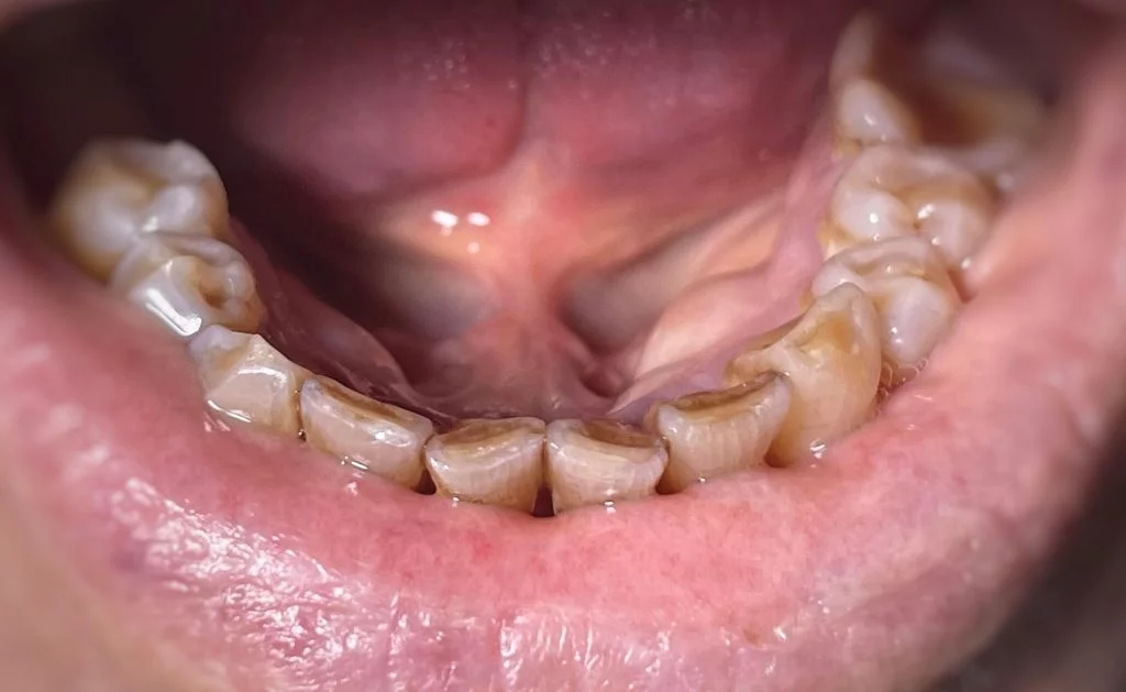 Почему происходит стираемость зубов? - Стоматология "Мандарин" - 2
