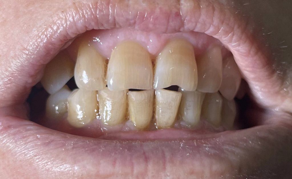 Почему происходит стираемость зубов? - Стоматология 
