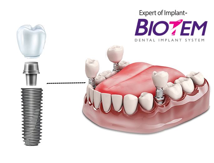 -50% на имплантацию зубов системой имплантов Biotem - Стоматология "Мандарин" - 1
