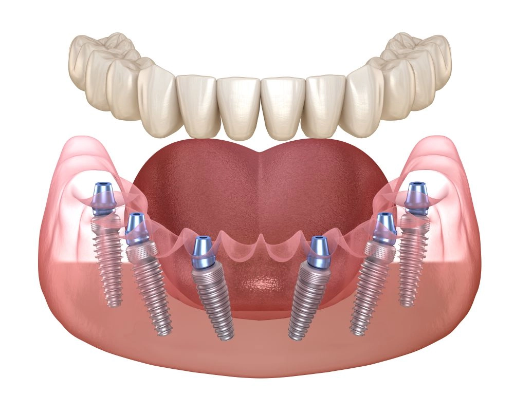 Имплантация зубов "All-on-6" на системе Neodent - Стоматология "Мандарин" - 1