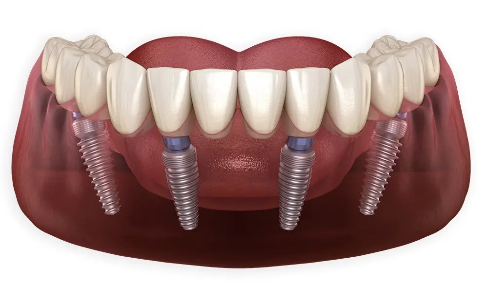 Имплантация зубов "All-on-4" на системе Neodent - Стоматология "Мандарин" - 1