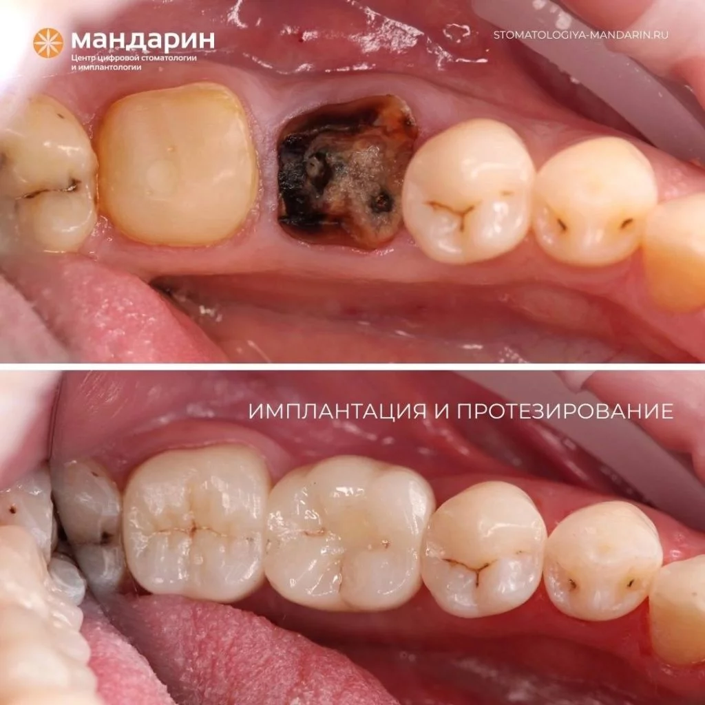 ДО и ПОСЛЕ удаления и восстановления зубов - Стоматология "Мандарин" - 1