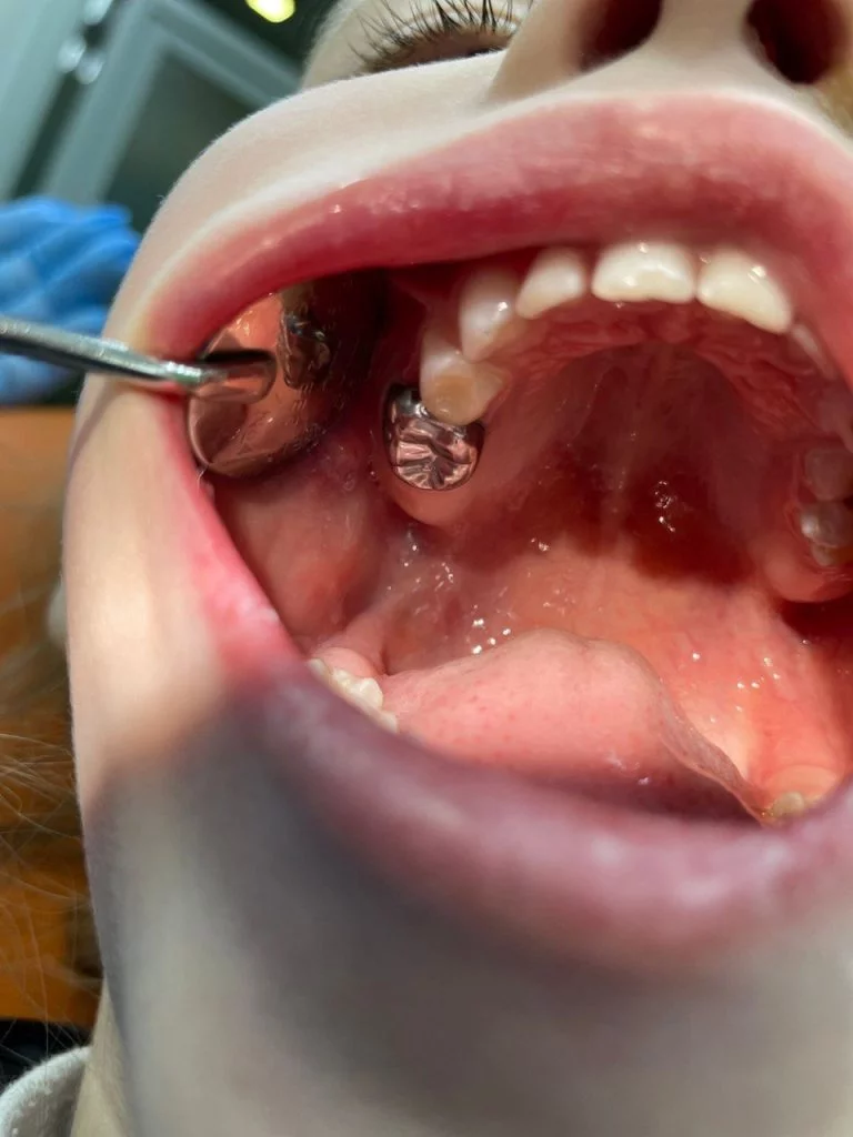 Детские зубные коронки - Стоматология "Мандарин" - 2