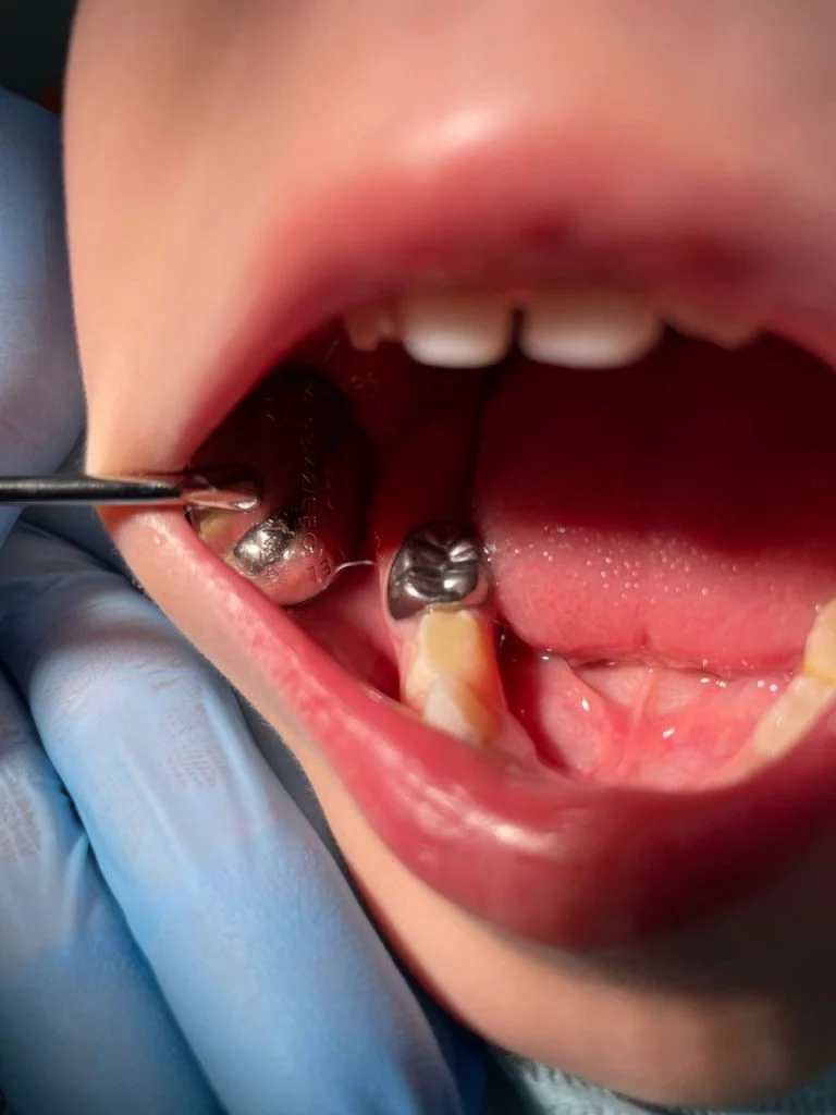 Детские зубные коронки - Стоматология "Мандарин" - 1