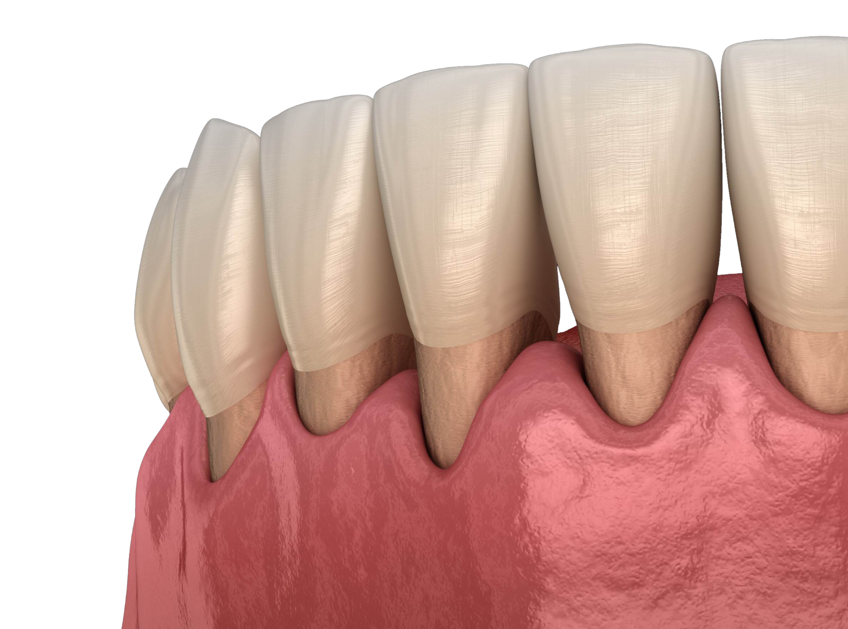 Имплантация зубов при пародонтите или пародонтозе - Стоматология 