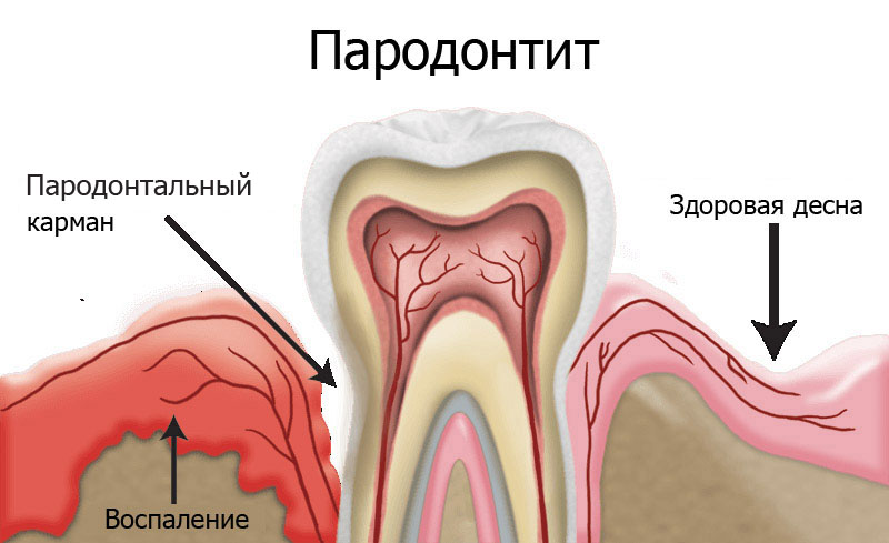 Имплантация зубов при пародонтите или пародонтозе - Стоматология 