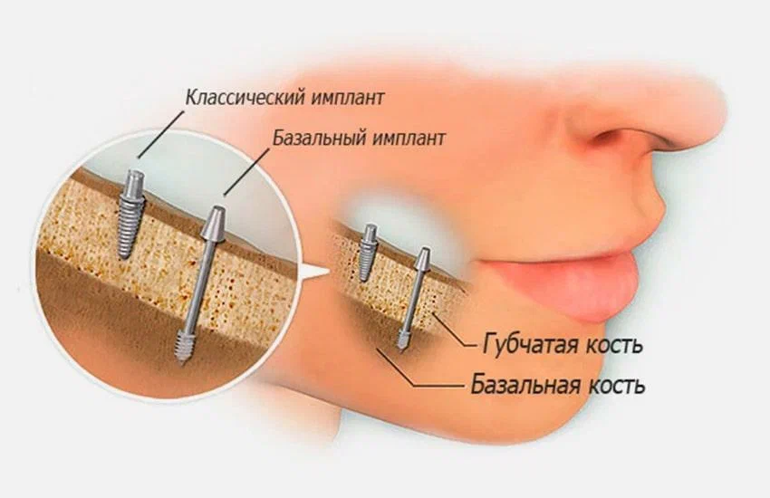 Имплантация зубов при пародонтите или пародонтозе - Стоматология "Мандарин" - 5
