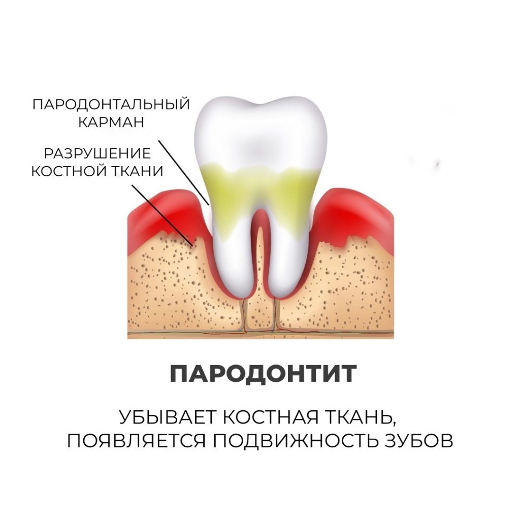 Опасность кровоточивости десен и болезненных ощущений во время чистки зубов - Стоматология 