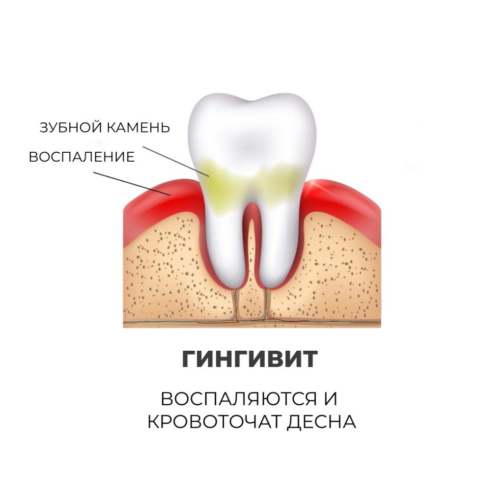 Опасность кровоточивости десен и болезненных ощущений во время чистки зубов - Стоматология 